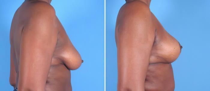 Before & After Breast Augmentation with Lift Case 25794 View #2 View in Alpharetta, GA