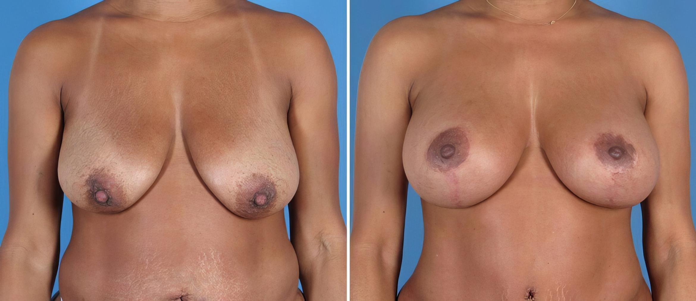 Before & After Breast Augmentation with Lift Case 26021 View #1 View in Alpharetta, GA