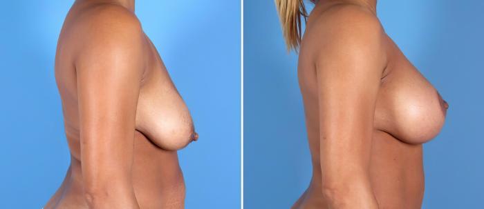 Before & After Breast Augmentation with Lift Case 26021 View #2 View in Alpharetta, GA