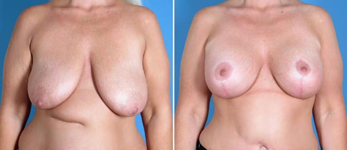 Before & After Breast Augmentation with Lift Case 26212 View #1 View in Alpharetta, GA