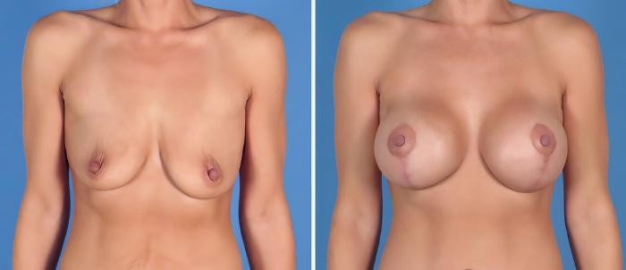 Before & After Breast Augmentation with Lift Case 27026 View #1 View in Alpharetta, GA