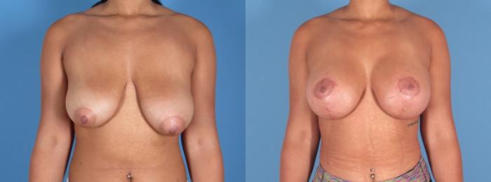 Before & After Breast Augmentation with Lift Case 28309 Front View in Alpharetta, GA