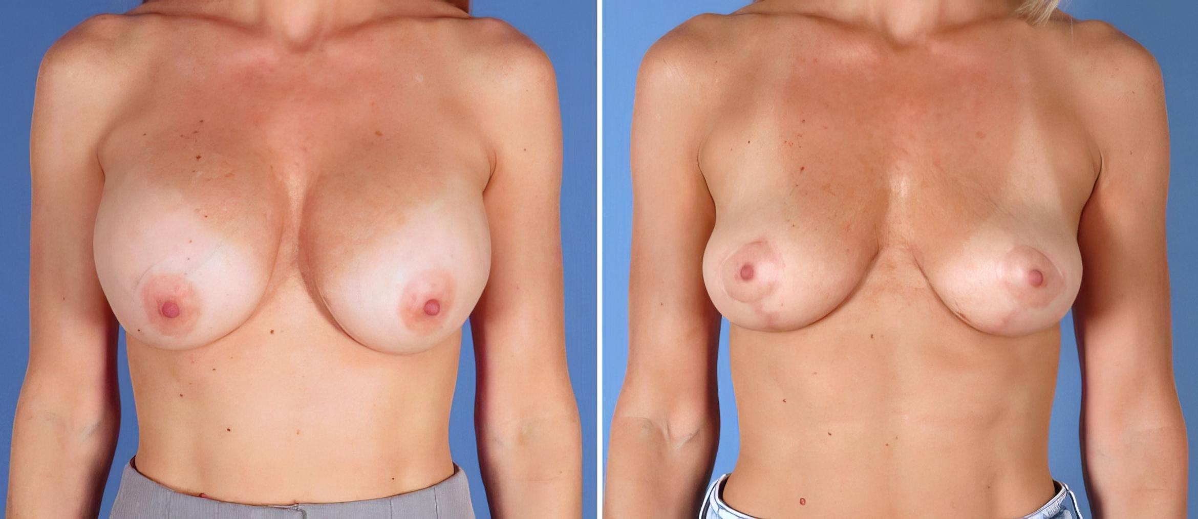 Before & After Breast Implant Removal Case 28294 View #1 View in Alpharetta, GA