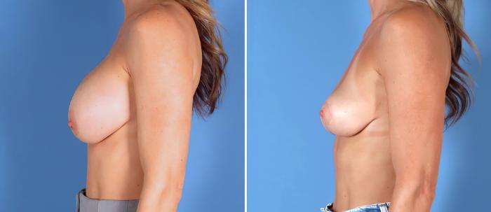 Before & After Breast Implant Removal Case 28294 View #3 View in Alpharetta, GA