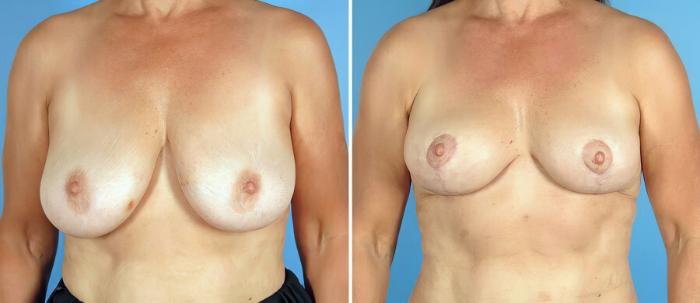 Before & After Breast Implant Revision Case 17511 View #1 View in Alpharetta, GA