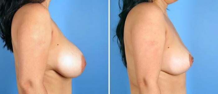 Before & After Breast Implant Revision Case 17633 View #2 View in Alpharetta, GA