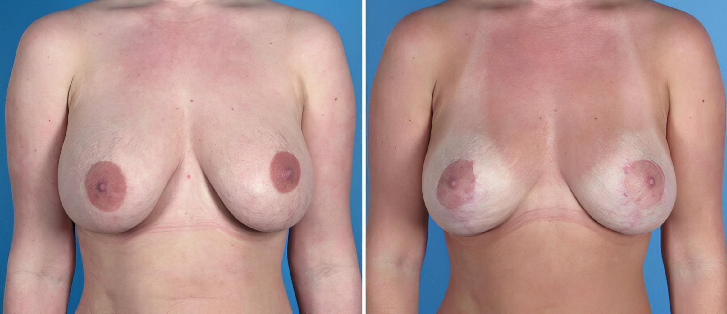 Before & After Breast Implant Revision Case 18095 View #1 View in Alpharetta, GA
