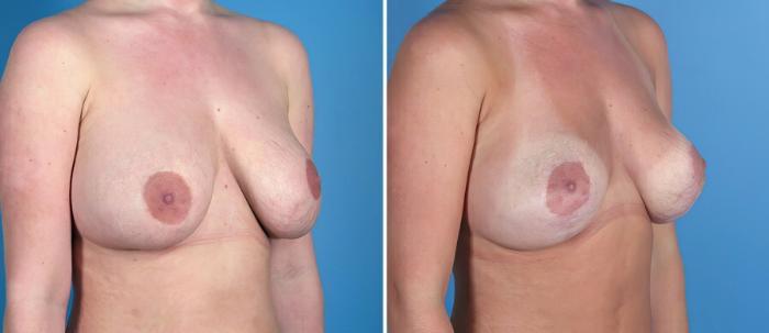 Before & After Breast Implant Revision Case 18095 View #2 View in Alpharetta, GA