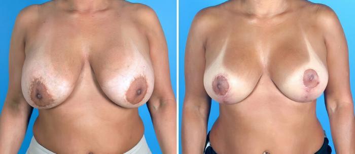 Before & After Breast Implant Revision Case 19240 View #1 View in Alpharetta, GA
