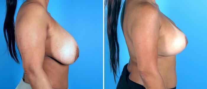 Before & After Breast Implant Revision Case 19240 View #2 View in Alpharetta, GA