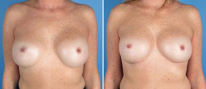 Before & After Breast Implant Revision Case 19516 View #1 View in Alpharetta, GA