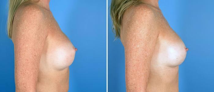 Before & After Breast Implant Revision Case 19516 View #2 View in Alpharetta, GA