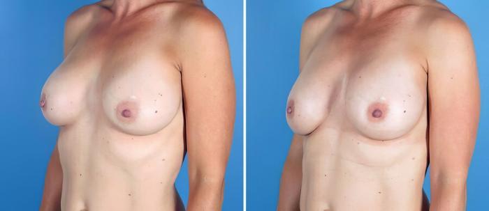 Before & After Breast Implant Revision Case 19519 View #2 View in Alpharetta, GA