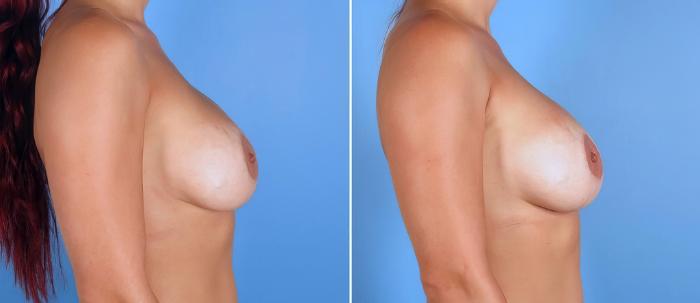 Before & After Breast Implant Revision Case 19522 View #2 View in Alpharetta, GA