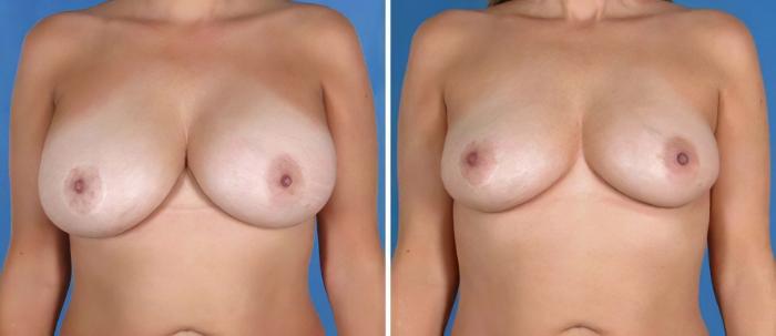 Before & After Breast Implant Revision Case 19860 View #1 View in Alpharetta, GA