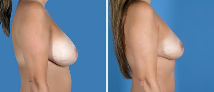 Before & After Breast Implant Revision Case 19860 View #2 View in Alpharetta, GA