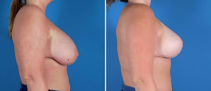 Before & After Breast Implant Revision Case 22940 View #2 View in Alpharetta, GA