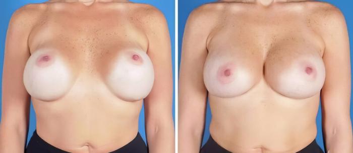 Before & After Breast Implant Revision Case 25175 View #1 View in Alpharetta, GA