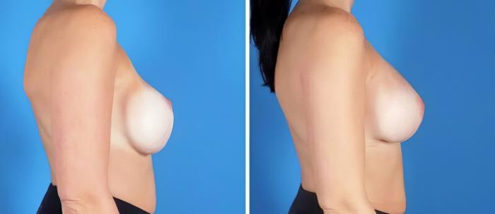 Before & After Breast Implant Revision Case 25175 View #2 View in Alpharetta, GA