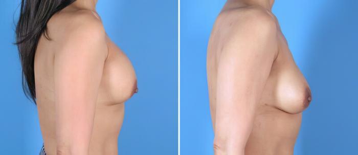 Before & After Breast Implant Revision Case 25645 View #2 View in Alpharetta, GA