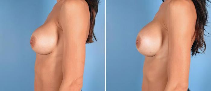 Before & After Breast Implant Revision Case 25779 View #2 View in Alpharetta, GA