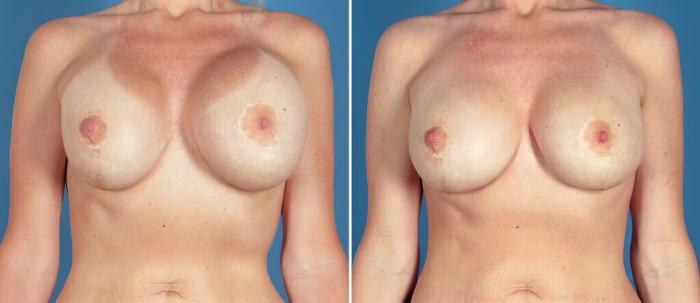 Before & After Breast Implant Revision Case 26152 View #1 View in Alpharetta, GA