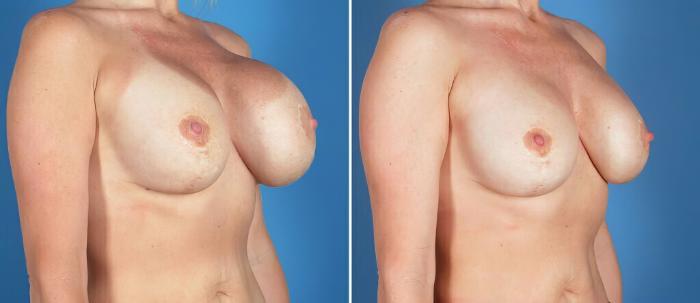 Before & After Breast Implant Revision Case 26152 View #2 View in Alpharetta, GA