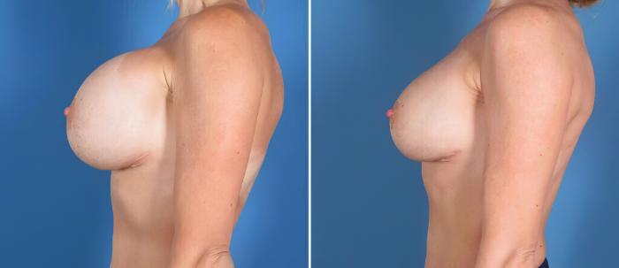Before & After Breast Implant Revision Case 26152 View #3 View in Alpharetta, GA