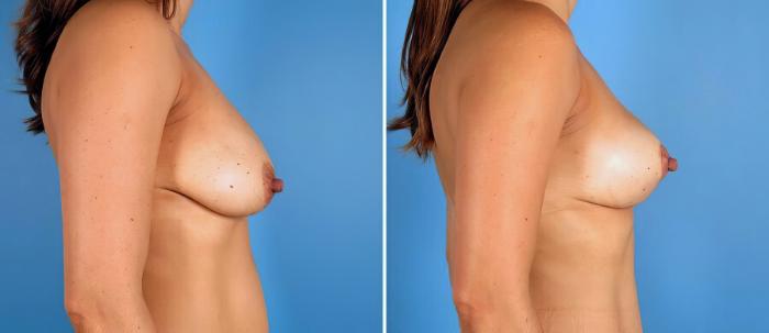 Before & After Breast Lift Case 17376 View #2 View in Alpharetta, GA