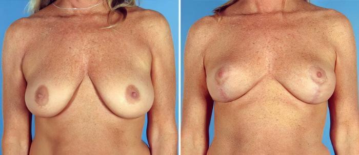 Before & After Breast Lift Case 17775 View #1 View in Alpharetta, GA