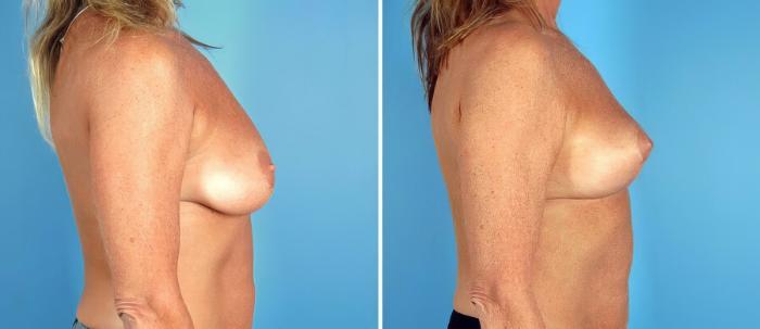 Before & After Breast Lift Case 17775 View #2 View in Alpharetta, GA