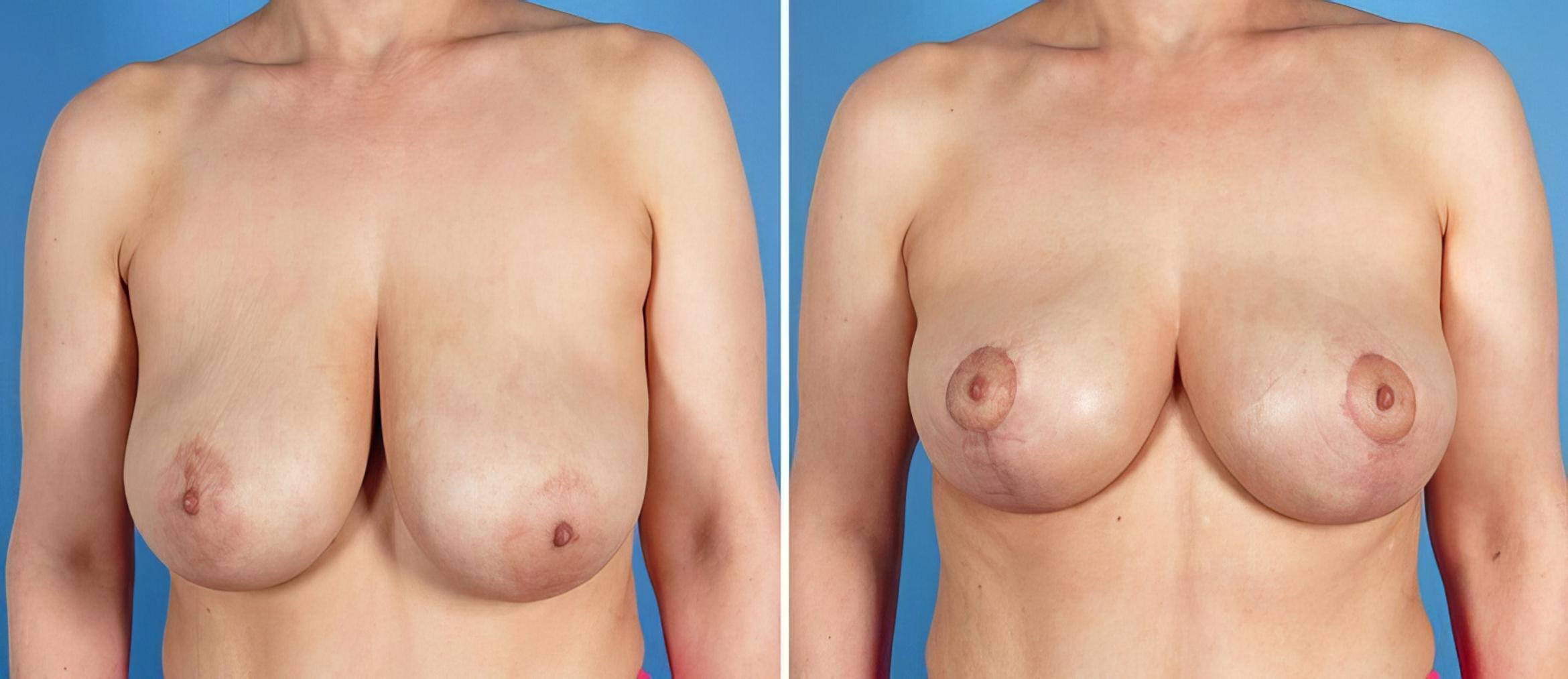 Before & After Breast Lift Case 17778 View #1 View in Alpharetta, GA