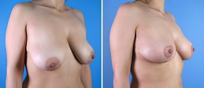 Before & After Breast Lift Case 17886 View #2 View in Alpharetta, GA