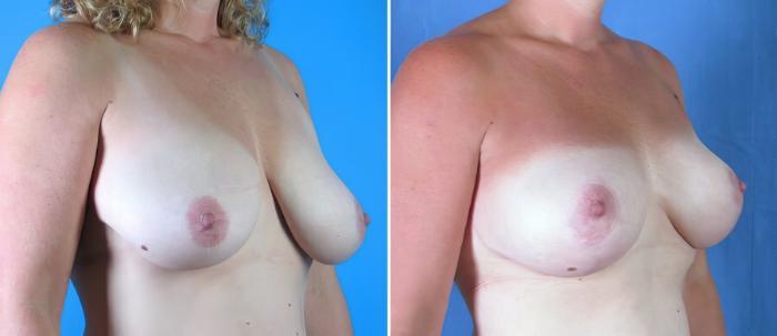 Before & After Breast Lift Case 17892 View #1 View in Alpharetta, GA