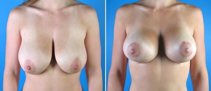 Before & After Breast Lift Case 17916 View #1 View in Alpharetta, GA