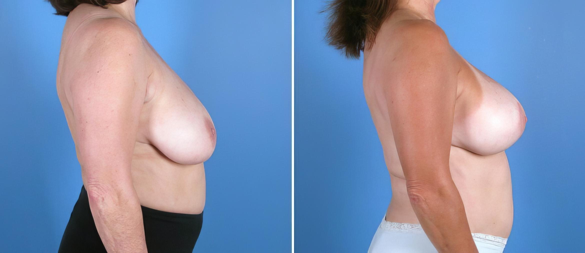 Before & After Breast Lift Case 17941 View #1 View in Alpharetta, GA