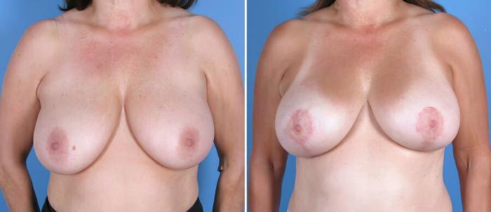 Before & After Breast Lift Case 17941 View #2 View in Alpharetta, GA
