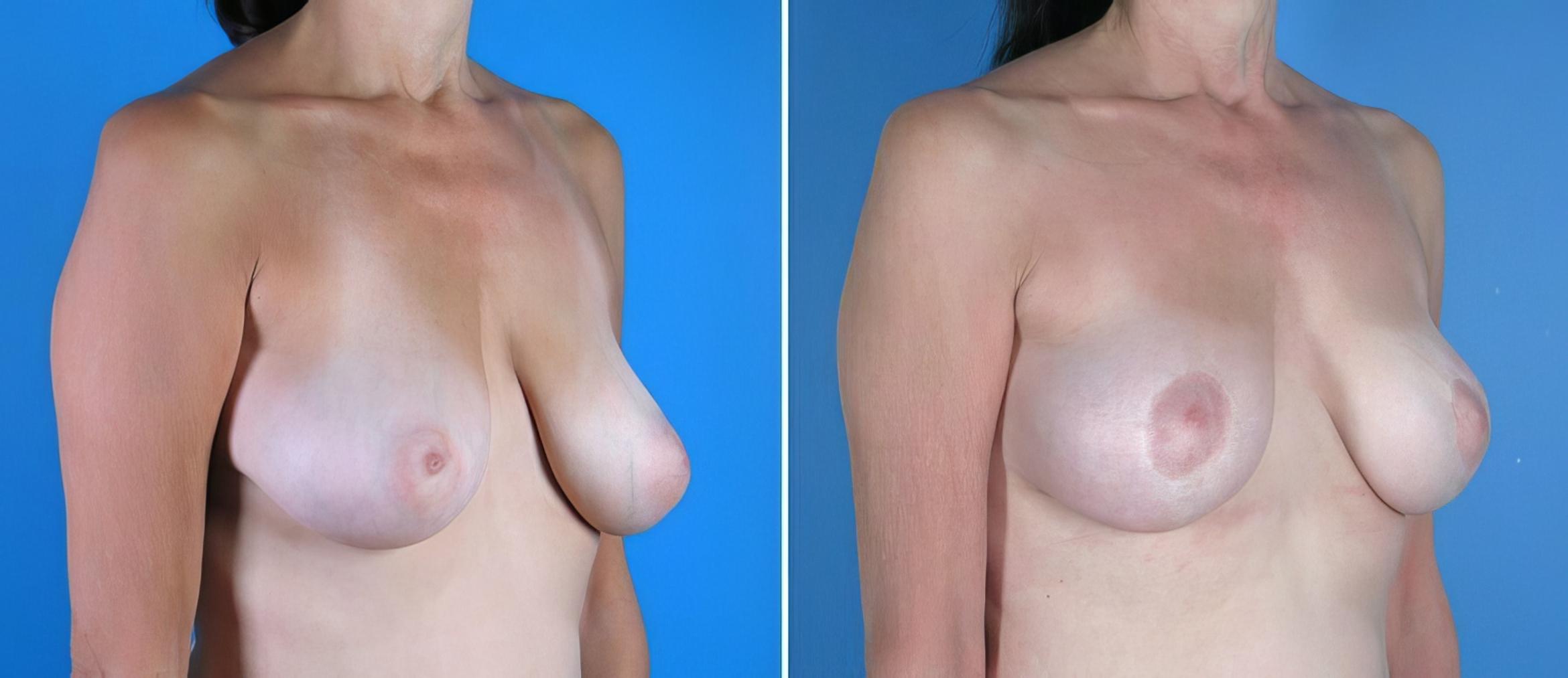 Before & After Breast Lift Case 17951 View #1 View in Alpharetta, GA