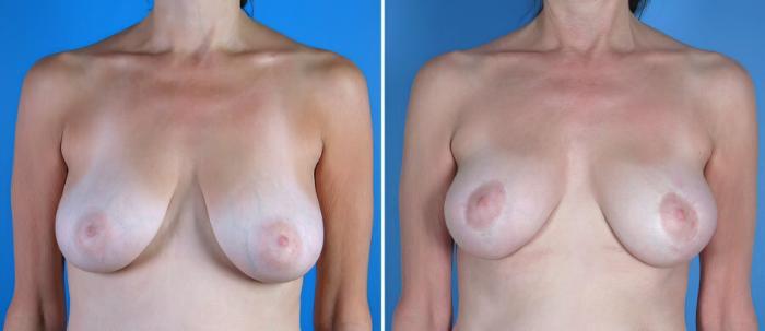 Before & After Breast Lift Case 17951 View #2 View in Alpharetta, GA
