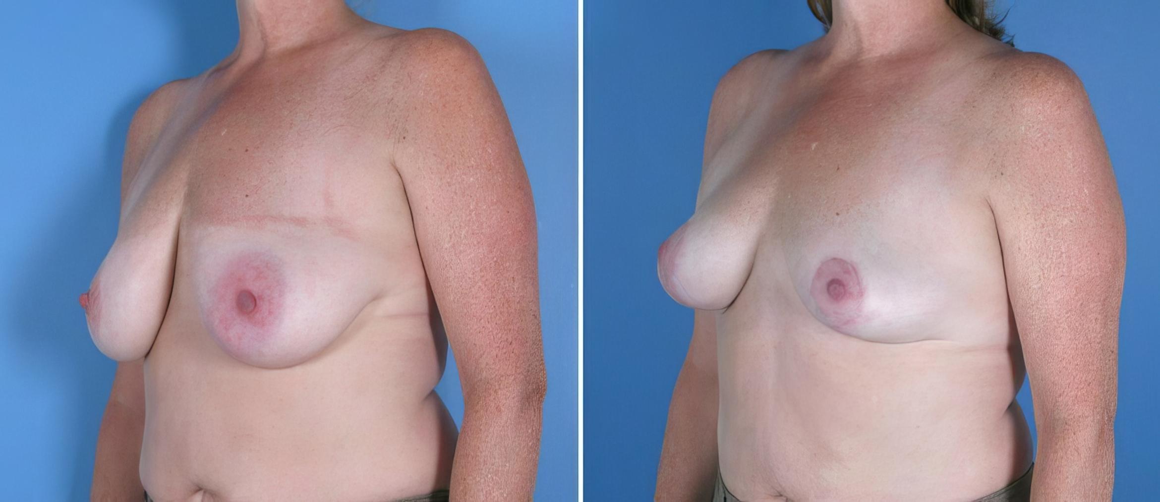 Before & After Breast Lift Case 17954 View #1 View in Alpharetta, GA