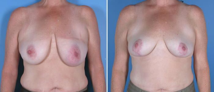 Before & After Breast Lift Case 17954 View #2 View in Alpharetta, GA