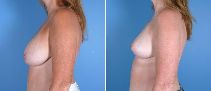 Before & After Breast Lift Case 17957 View #1 View in Alpharetta, GA