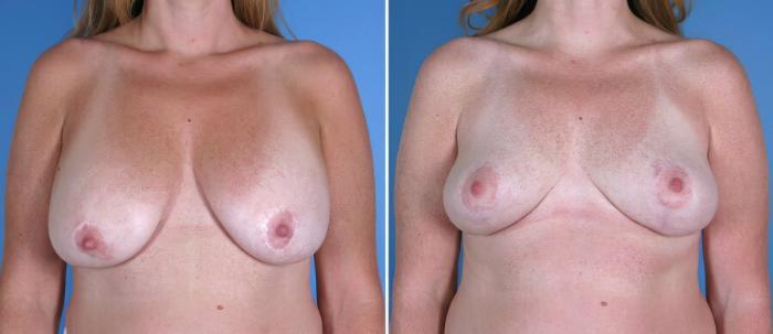 Before & After Breast Lift Case 17957 View #2 View in Alpharetta, GA