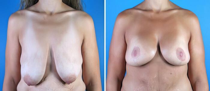 Before & After Breast Lift Case 17963 View #2 View in Alpharetta, GA