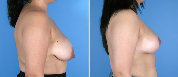 Before & After Breast Lift Case 17966 View #1 View in Alpharetta, GA