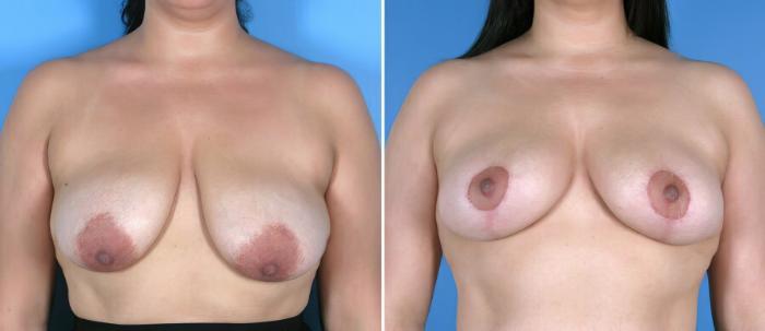 Before & After Breast Lift Case 17966 View #2 View in Alpharetta, GA