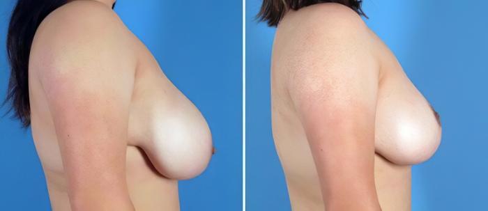 Before & After Breast Lift Case 25504 View #2 View in Alpharetta, GA