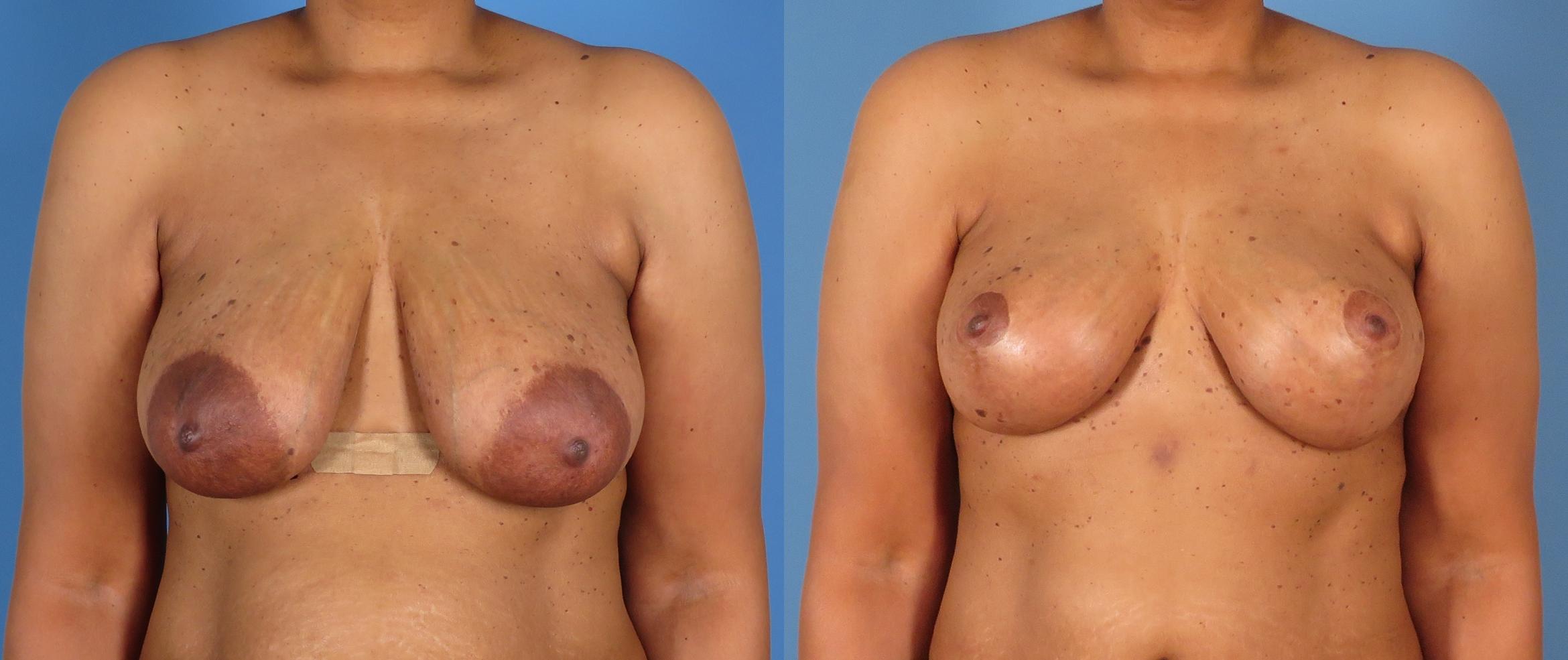 Before & After Breast Lift Case 28307 Front View in Alpharetta, GA