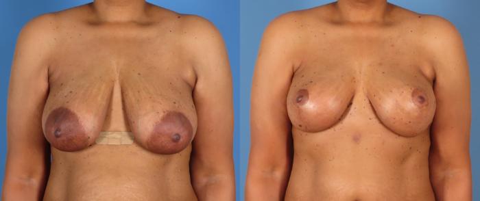 Before & After Breast Lift Case 28307 Front View in Alpharetta, GA