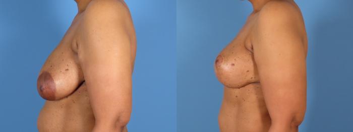 Before & After Breast Lift Case 28307 Left Side View in Alpharetta, GA